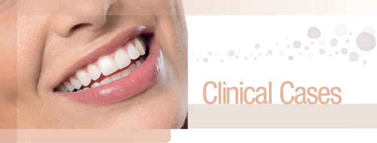 Lava Crowns Clinical Case