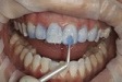 Lava Veneers Using Lava Ultimate CAD/CAM restorative Lava Veneers Using Lava Ultimate CAD/CAM restorative