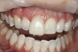 Lava Veneers Using Lava Ultimate CAD/CAM restorative Lava Veneers Using Lava Ultimate CAD/CAM restorative