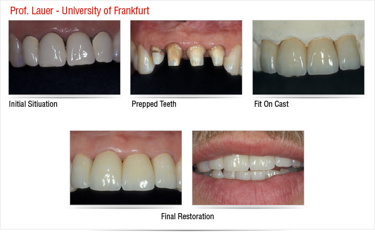 Crowns Prepration and final Restoration