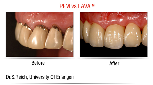 pfm crowns vs lava crowns